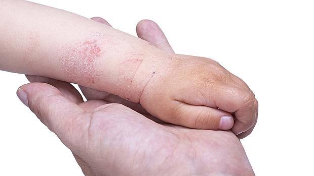 dermatitis--620x349