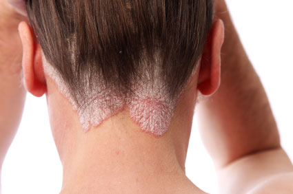 psoriasis-neck